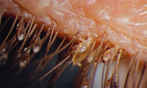 crabs STD (pubic lice) 15