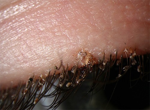 Crabs STD (Pubic lice) detailed Pictures & Images