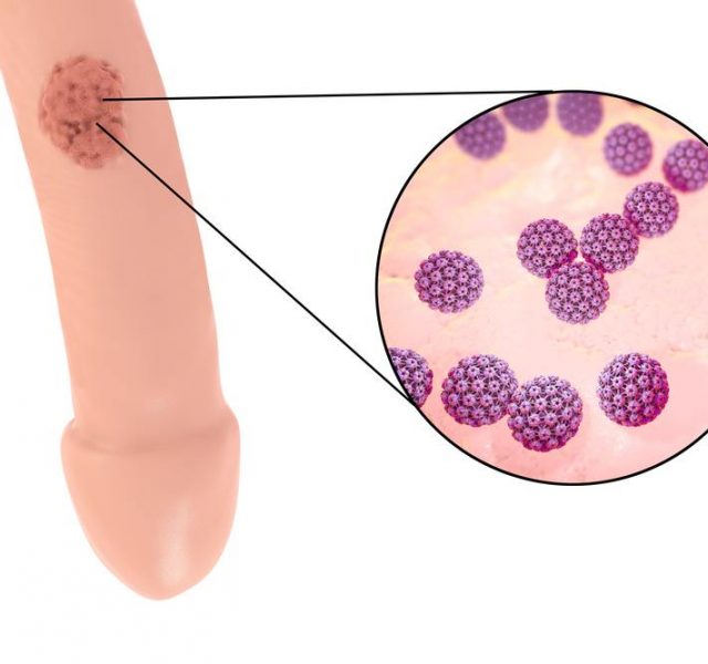 Common locations of genital warts, Human papillomavirus HPV lesions in men, and close-up view of HPV