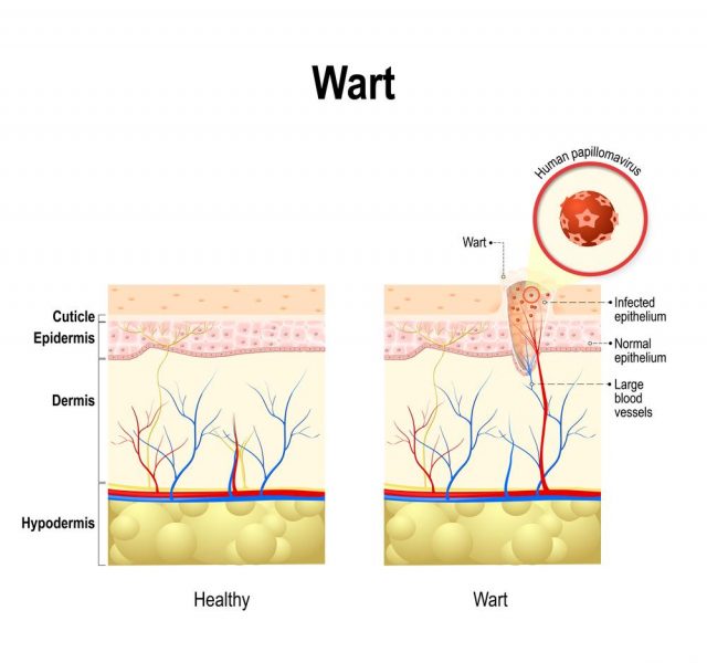 Wart. Cross section of the human skin with Human papillomavirus infection. HPV is a virus which causes warts and cervical cancer.