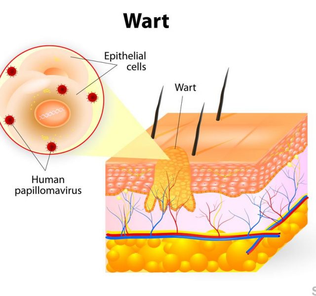 Anatomy of Wart