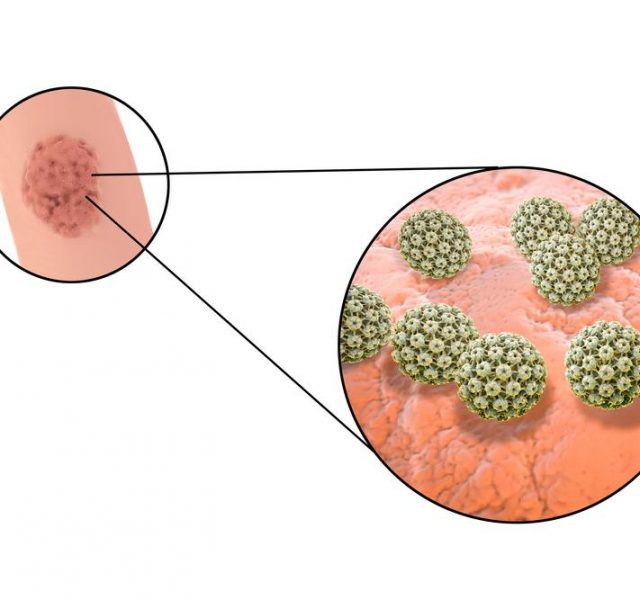 Human papillomavirus HPV lesions in men, genital warts, and close-up view of HPV. 3D illustration