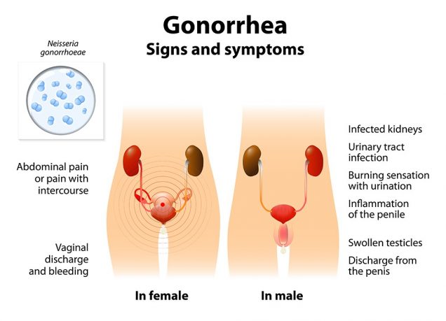 Gonorrhea signs and symptoms