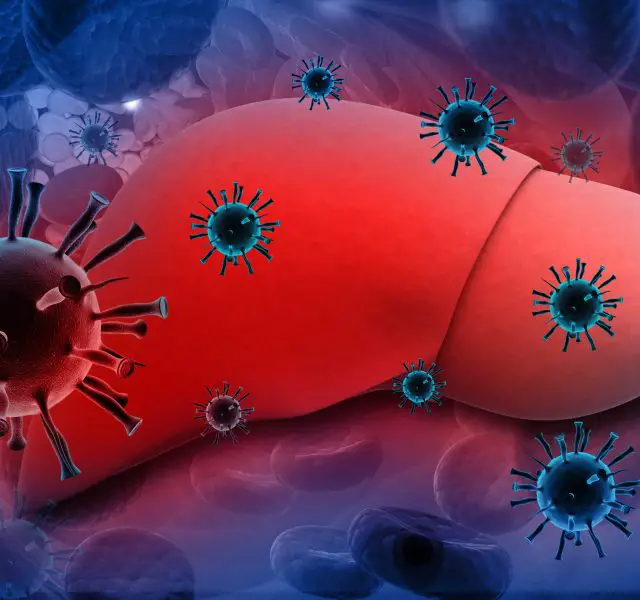 Liver Infection with hepatitis viruses