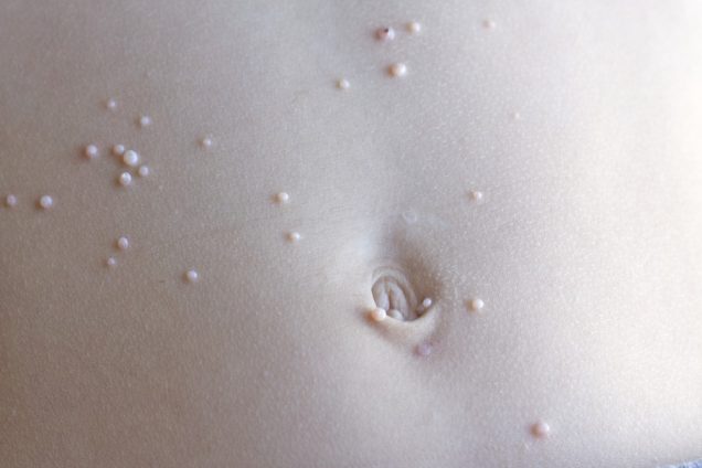 Molluscum Contagiosum Symptoms