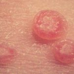 molluscum_contagiosum