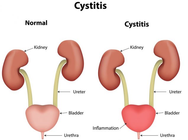 Painful Urination (Dysuria): Cystitis