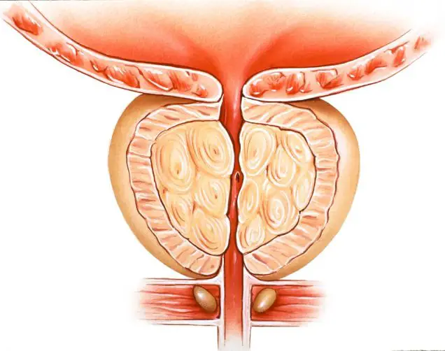 Painful Urination (Dysuria): Prostatitis