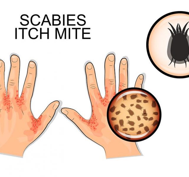 illustration of hand, infected scabies and scabies mite