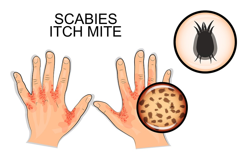 Itching Hands Cartoons Scabies Causes Symptoms Treatment Pictures Images