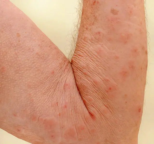 Close up of an elderly man's inner arm severely infested with Scapies mites (Sarcoptes scabiei)