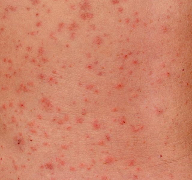 Close up image of a patch of human skin with a severe skin rash