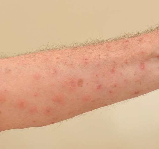 Close up of an elderly man's inner forearm arm severely infested with Scapies mites (Sarcoptes scabiei)