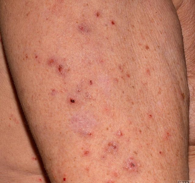 Close up of an elderly man's upper arm infested with Scapies mites (Sarcoptes scabiei)