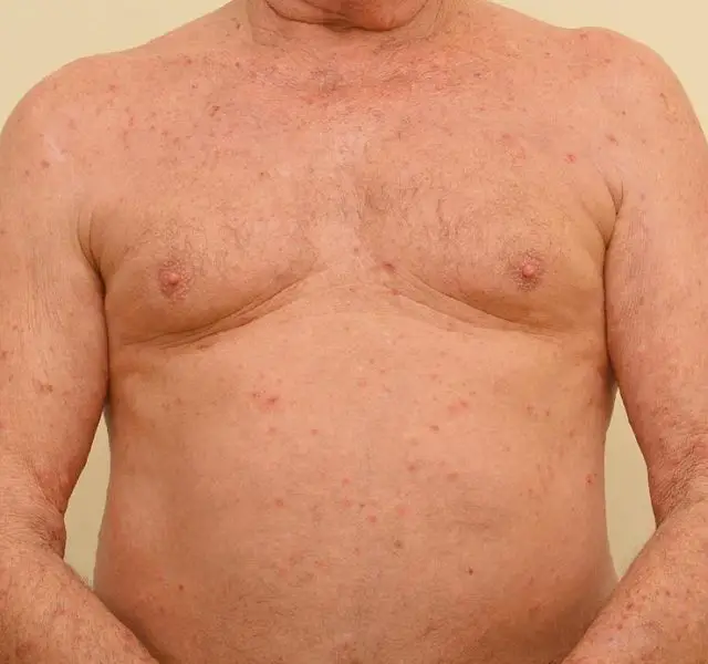 Close up of an elderly man's chest , stomach and arms severely infested with Scapies mites (Sarcoptes scabiei)