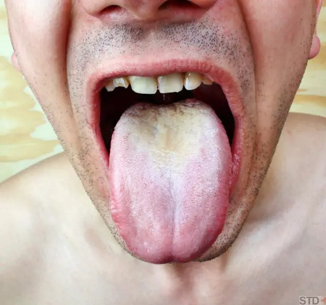 Infection tongue disease candida albicans