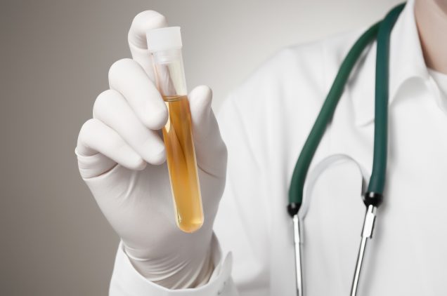 Doctor holding a bottle of dark urine sample