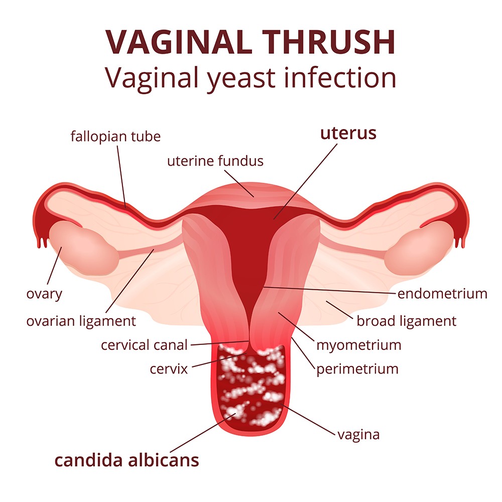 reproductive tract infection symptoms