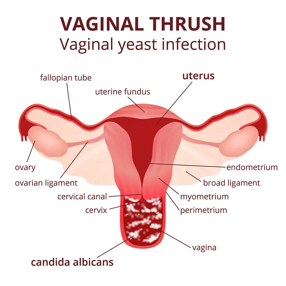 Vaginal Yeast Infection Symptoms Treatment Std Vaginal Yeast