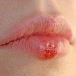 Herpes (Herpes Simplex)